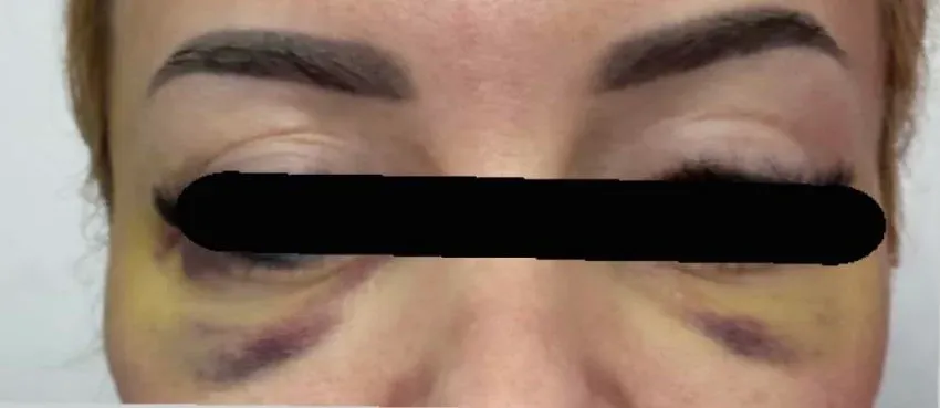 Baranka nakon estetskog tretmana lica mezonitima radila i skener glave, vlasnica salona “pod lupom” tužilaštva